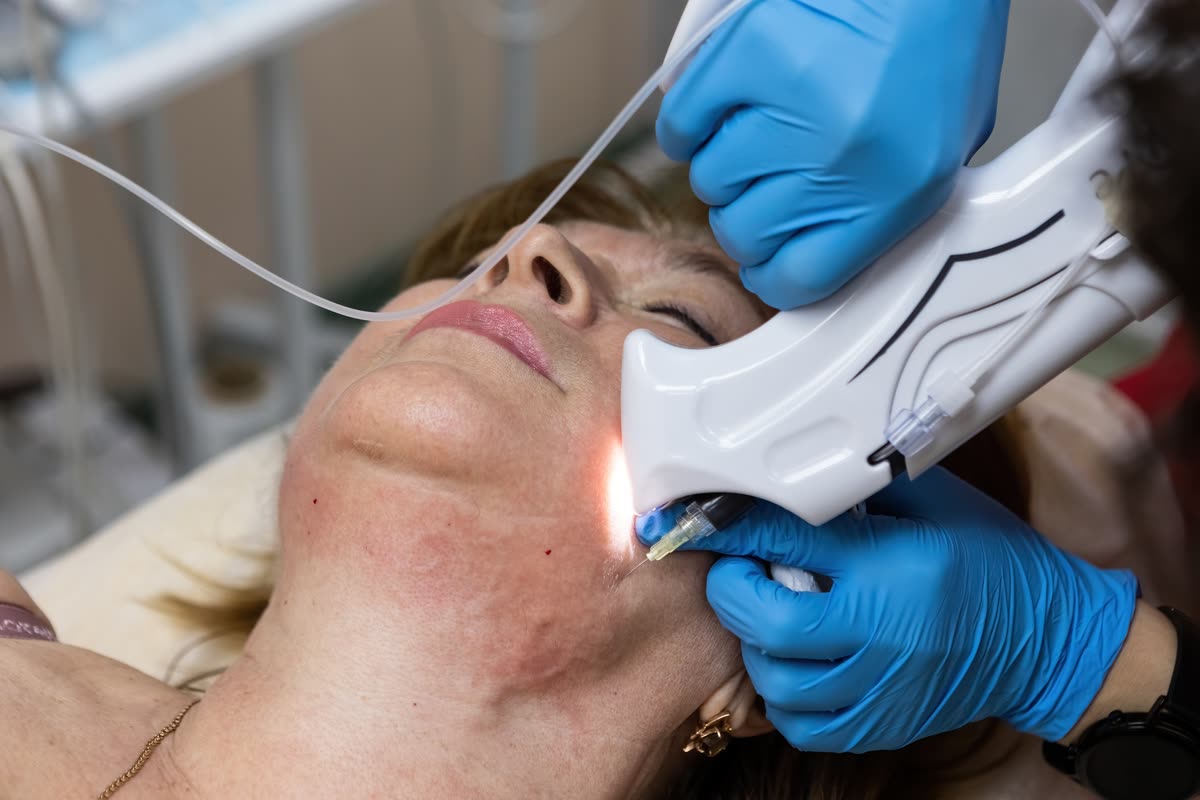 Laser Vessel Removal